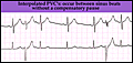 ecg_inter_pvc.gif